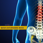 Spinal Cord Stimulator Implant in Plano, Frisco, McKinney and Allen